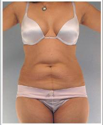 Tummy Tuck Before and After Pictures Houston, TX