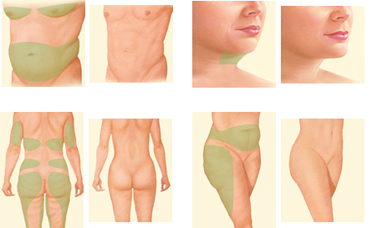 Shu Cosmetic Surgery of Twin Cities Now Offers Total Body Liposuction